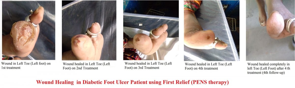 Wound healing in diabetic foot ulcer patient using First Relief